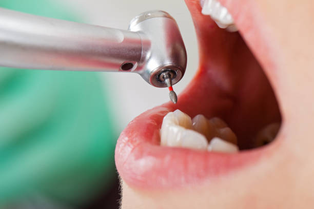 Best Dental Abscess Treatment in Williamsport, IN